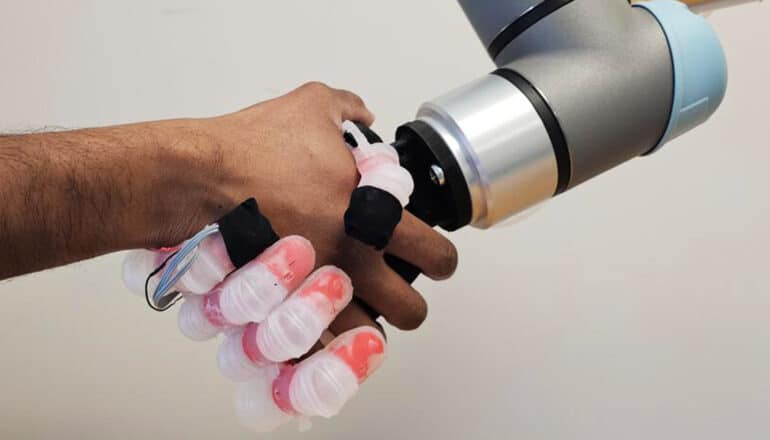 A person shakes hand with the new prosthetic hand.